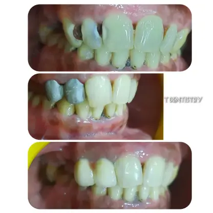 Crowns for teeth in RS Puram Coimbatore