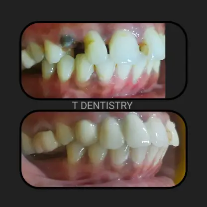 Crowns for teeth in RS Puram Coimbatore