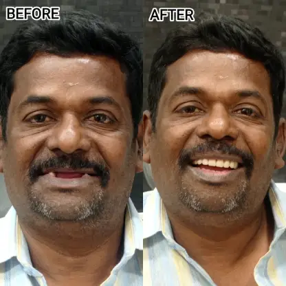 Cosmetic Dentistry in RS Puram,Coimbatore