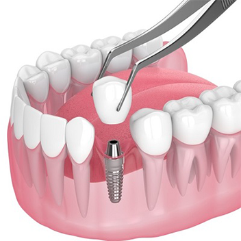 Dental implant RS Puram
