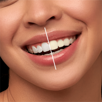 Teeth whitening in coimbatore