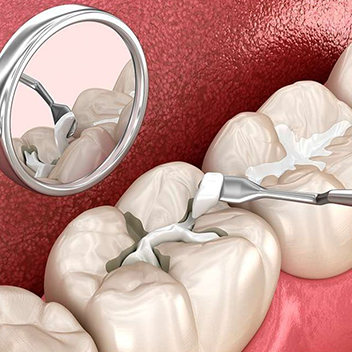 Dental filling in RS Puram Coimbatore