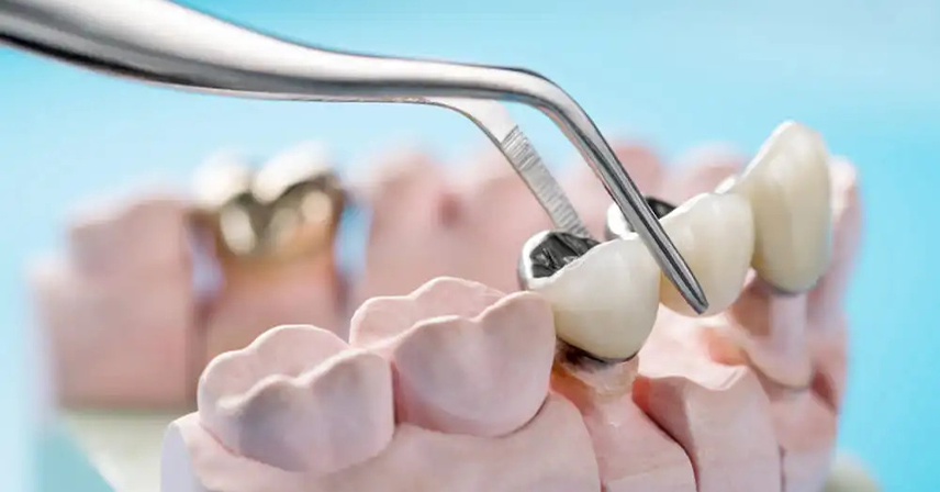 Crowns for teeth in RS Puram Coimbatore