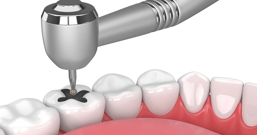 Teeth Filling in RS Puram Coimbatore
