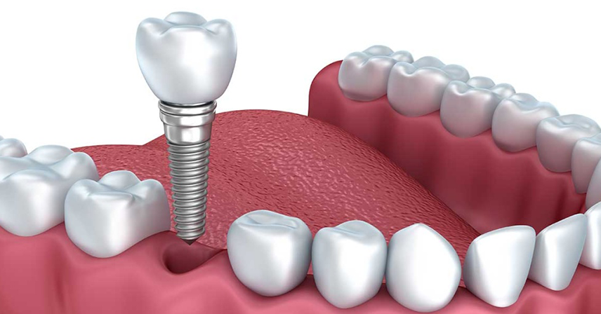Dental implant in RS Puram,Coimbatore