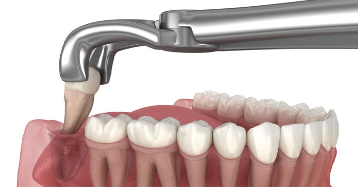 Teeth Removal in RS Puram,Coimbatore
