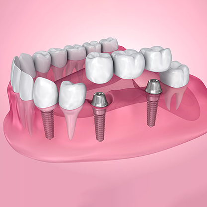 Dental implant in RS Puram,Coimbatore