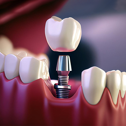 Dental implant in RS Puram,Coimbatore