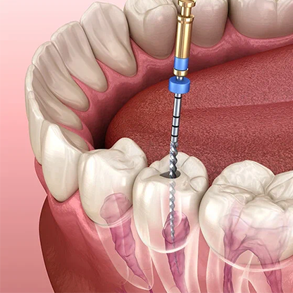 Root Canal Treatment in RS Puram Coimbatore 