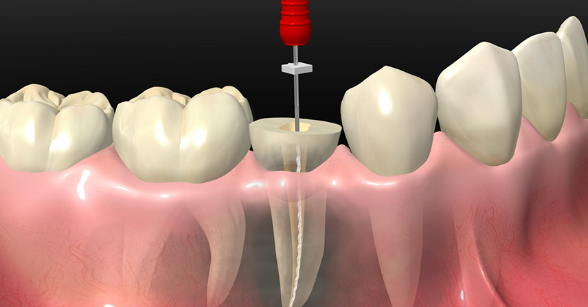 Root Canal Treatment in RS Puram Coimbatore 