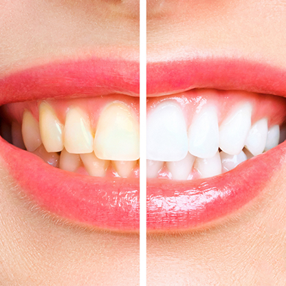 Teeth Whitening in RS Puram,Coimbatore