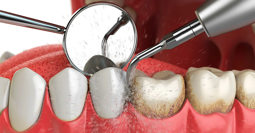 Deep cleaning teeth in RS Puram Coimbatore