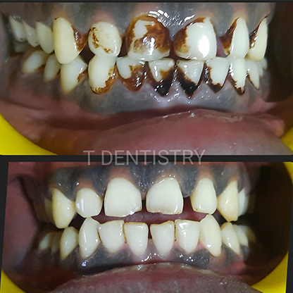 Deep cleaning teeth in RS Puram Coimbatore