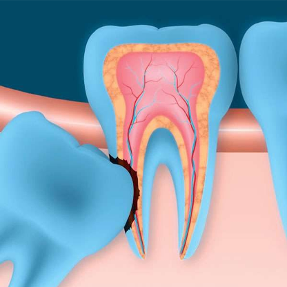 Wisdom Tooth Removal in RS Puram,Coimbatore