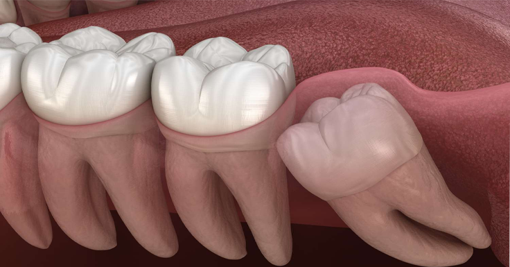 Wisdom Tooth Removal in RS Puram,Coimbatore